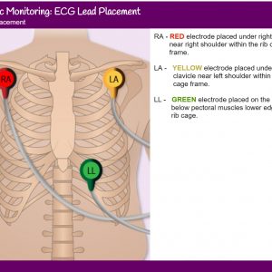 3 lead ECG placement